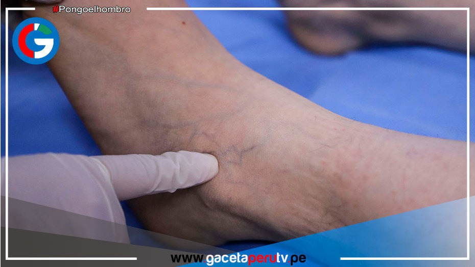 Hospital Rebagliati reporta 60,000 casos asociados a trombosis en los últimos seis meses