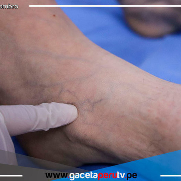 Hospital Rebagliati reporta 60,000 casos asociados a trombosis en los últimos seis meses 