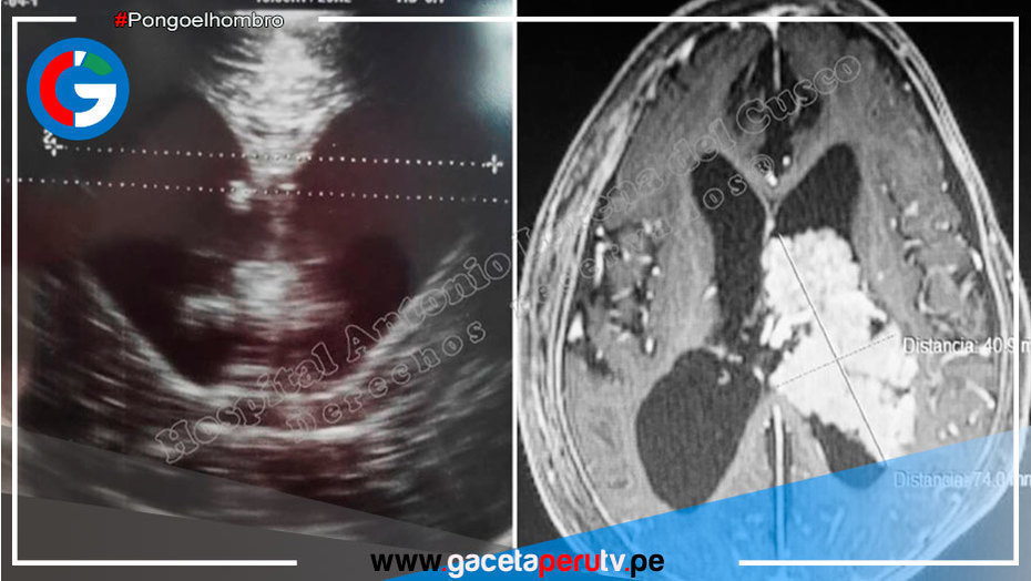 España: Un estudio genético revela la relación entre la salud del cerebro e intestino