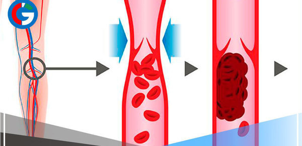 Pasar altas horas viendo series aumenta el riesgo de padecer Trombosis