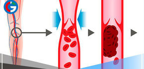 Pasar altas horas viendo series aumenta el riesgo de padecer Trombosis