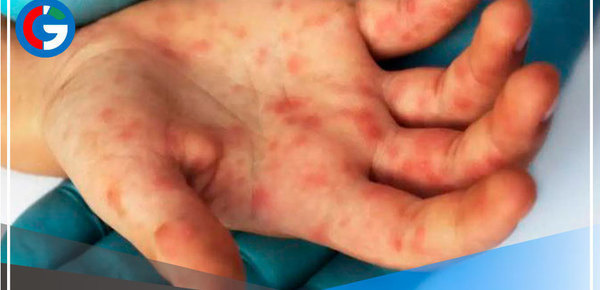 Viruela símica:  2,588 los casos en Perú