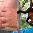 La OMS rebautiza la viruela del mono para evitar estigmatización a primates