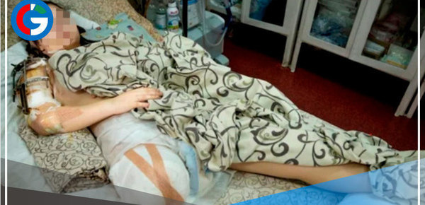 Amputan una pierna a una niña de 15 años por metrallas durante la invasión por parte de Rusia a Ucrania