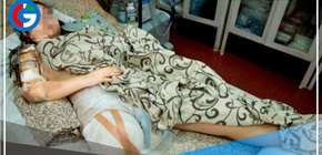 Amputan una pierna a una niña de 15 años por metrallas durante la invasión por parte de Rusia a Ucrania