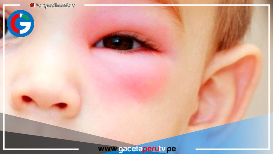 Trauma ocular es una amenaza para la visión de los niños
