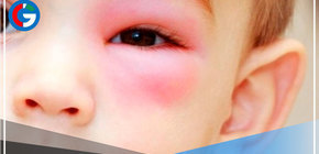 Trauma ocular es una amenaza para la visión de los niños