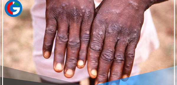 Países reportan casos de viruela del mono