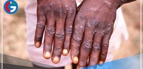 Países reportan casos de viruela del mono