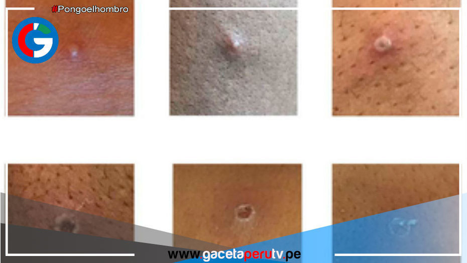 Israel y Suiza confirman primer caso de Viruela del Mono