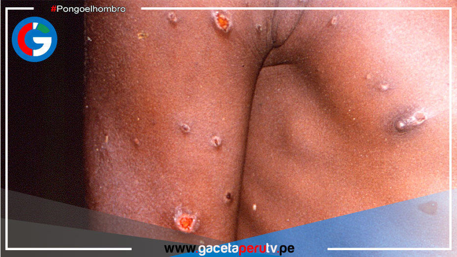 Mexicanos confirman primer caso de viruela del mono en su país