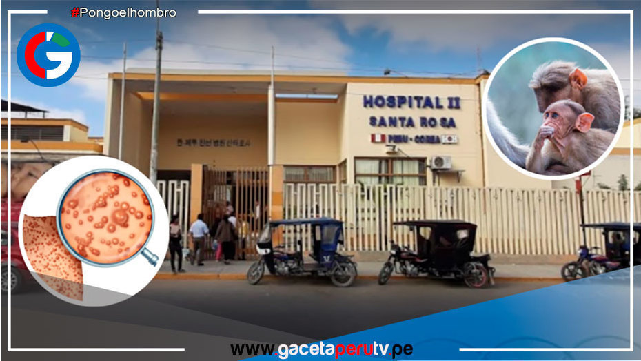 Investigan posible caso de viruela del mono en hombre de 70 años en Piura