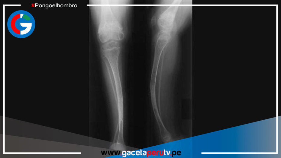 19 casos de osteogénesis imperfecta se registraron en enero del 2022