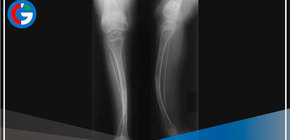 19 casos de osteogénesis imperfecta se registraron en enero del 2022 