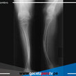 19 casos de osteogénesis imperfecta se registraron en enero del 2022 