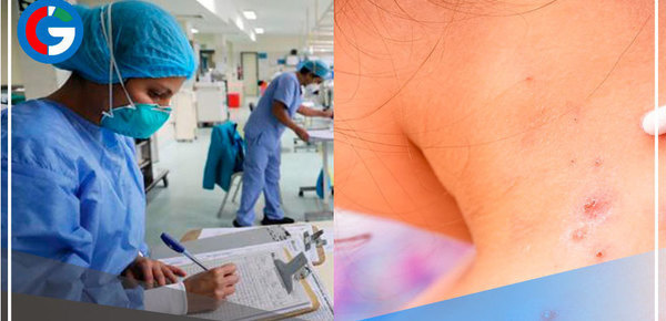 Confirman tres casos de viruela del mono en el país de Colombia 