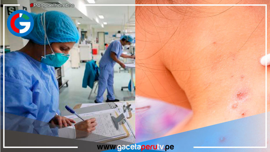 Confirman tres casos de viruela del mono en el país de Colombia