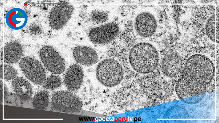 Ya son más de 700 casos de viruela del mono a nivel global