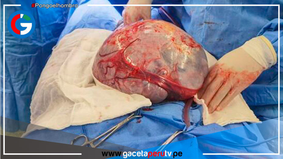 Villa El Salvador: especialistas extirpan tumor de 7 kilos a madre de familia