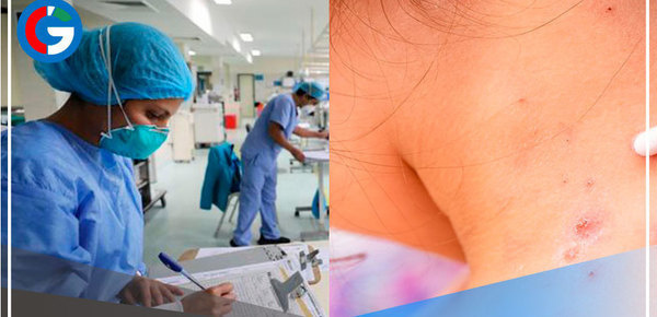 Viruela del mono: aumentan a 92 los casos en el Perú 