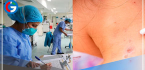 Viruela del mono: aumentan a 92 los casos en el Perú 