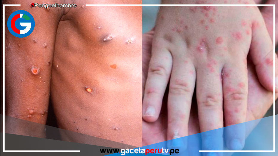 Activan a su máximo nivel de alerta por la viruela del mono
