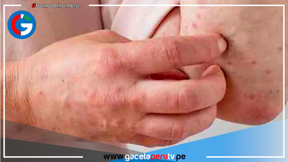 Minsa informa que se elevó a 224 los casos confirmados en el Perú de Viruela del Mono