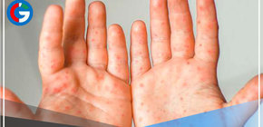 Viruela del mono: aumentan a 269 los casos en Perú