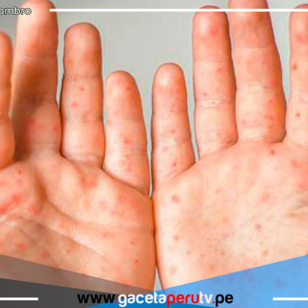Viruela del mono: aumentan a 269 los casos en Perú