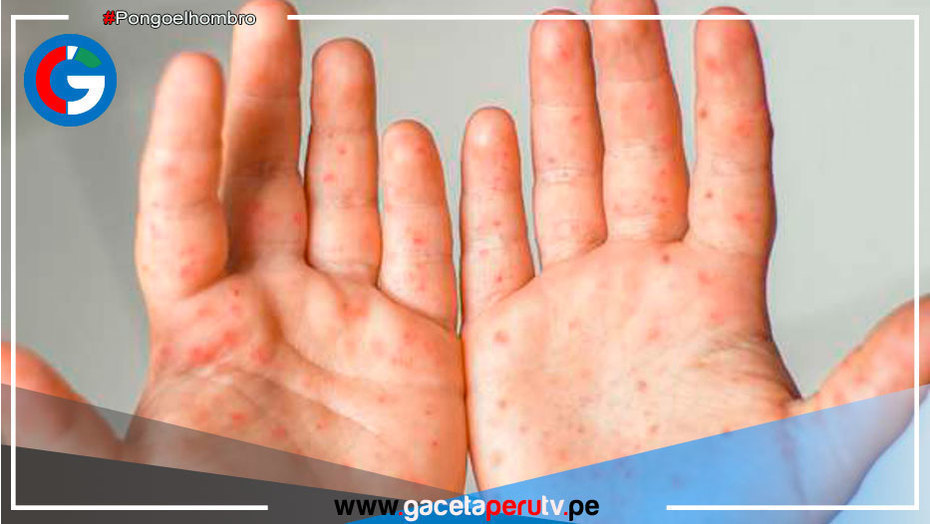 Viruela nueva: el 64.1 % de infectados en el Perú son personas con VIH