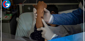 Síntomas y transmisión de la viruela del mono