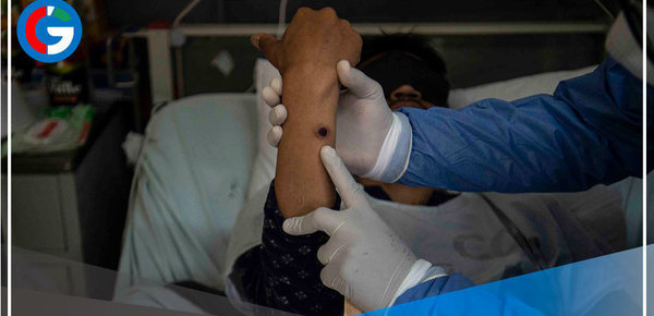 Viruela del mono: 1,342 los casos a nivel nacional