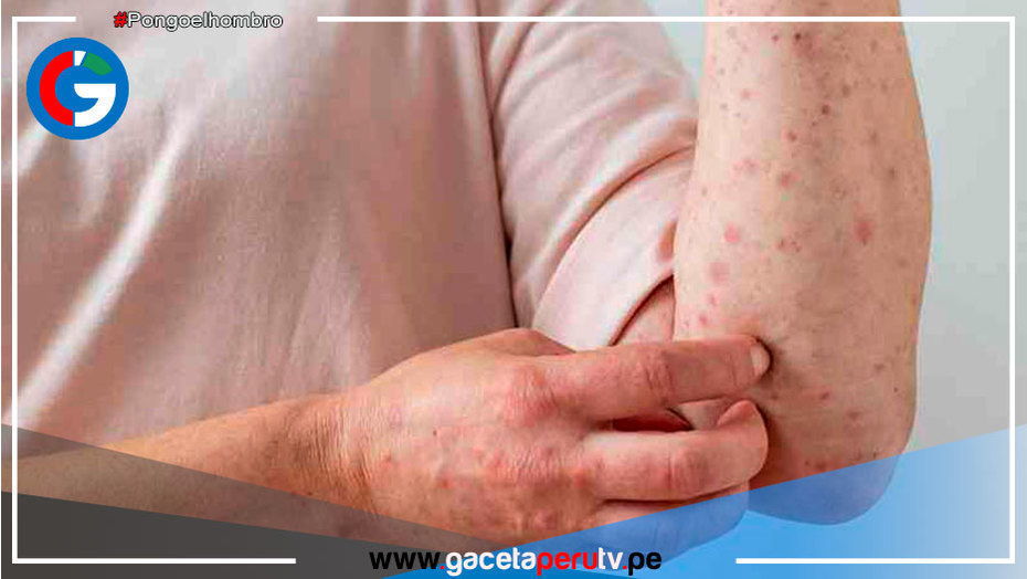 Viruela del mono: 324 casos confirmados en el Perú
