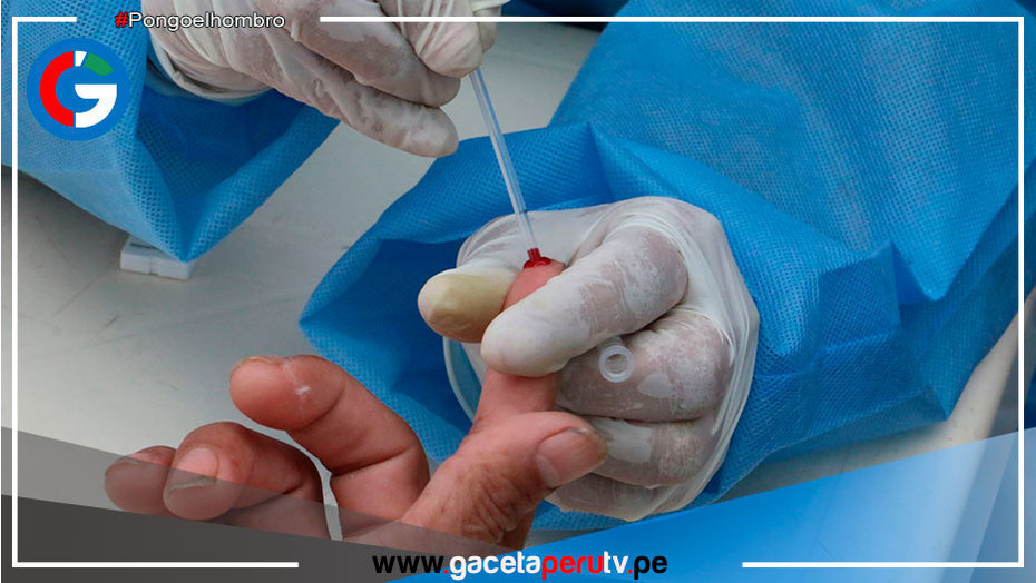 Viruela del mono: 340 casos en Perú