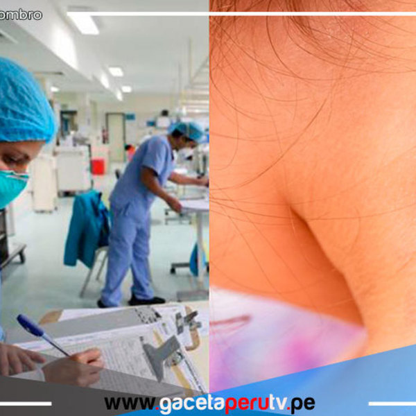 Viruela del mono: 1,531 casos en Perú