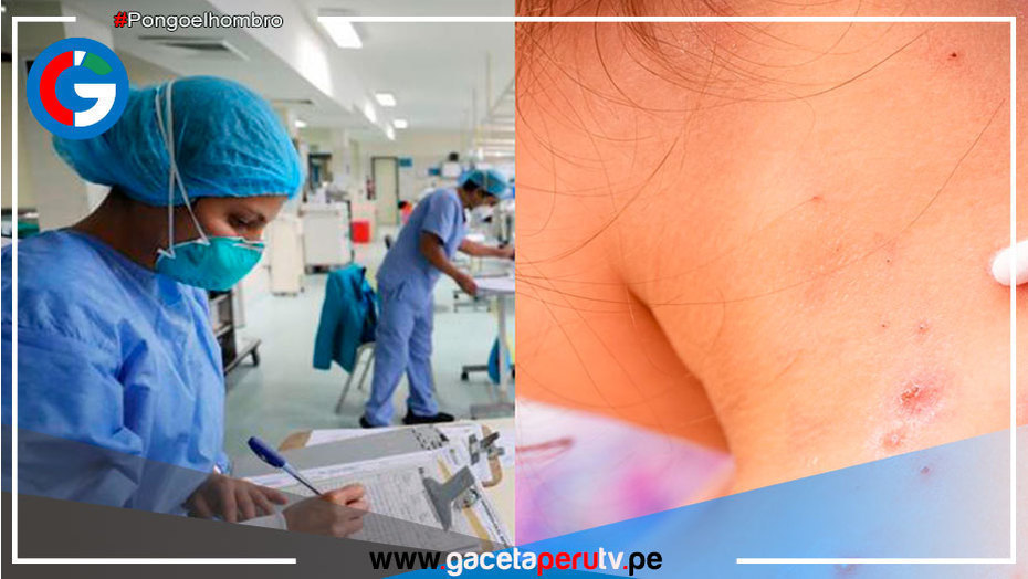 Viruela del mono: 1,531 casos en Perú