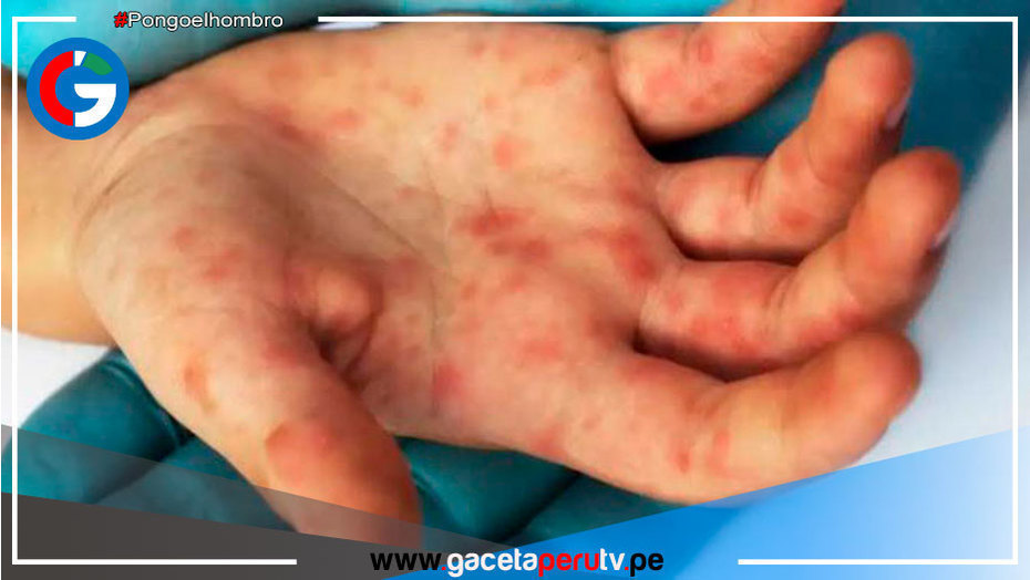 Identifican linaje peruano del virus de la viruela del mono