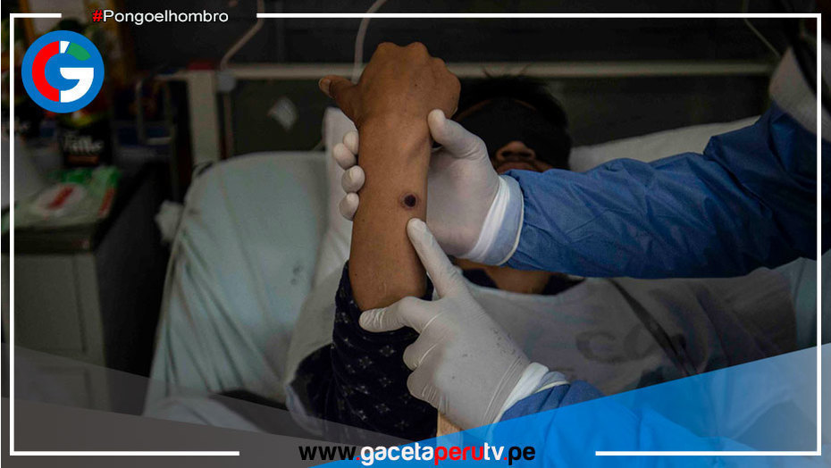 Viruela símica: 2,015 casos en Perú