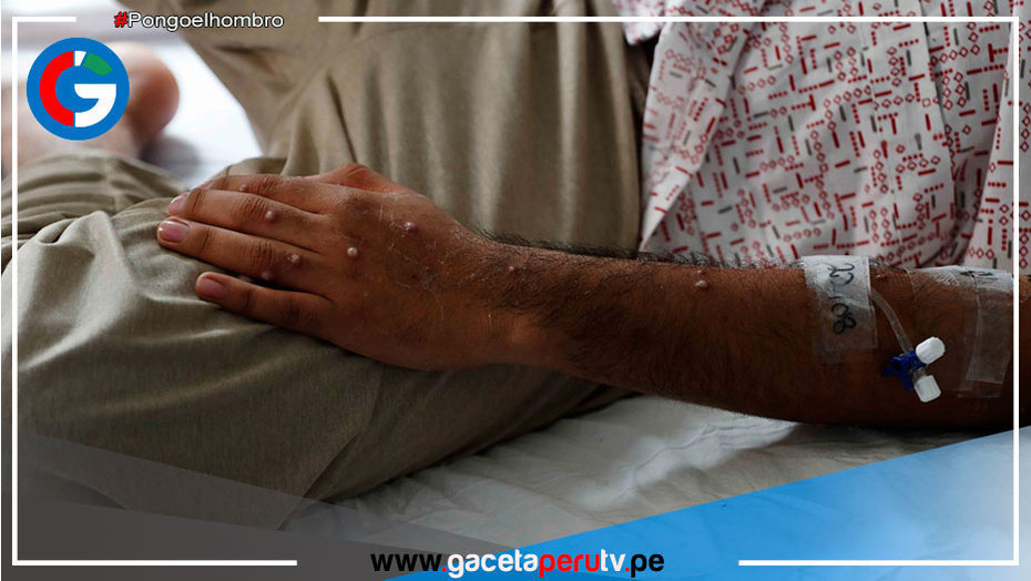 Viruela símica: 2,054 los casos en Perú