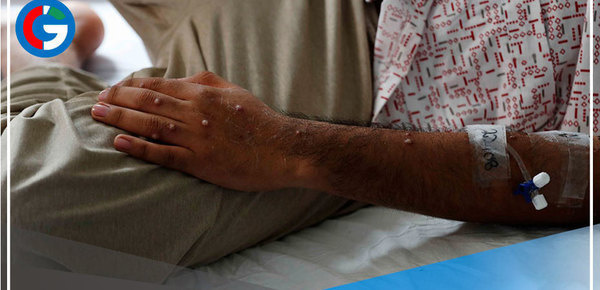 Viruela símica:  1,808 casos en Perú