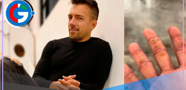 Enfermedad de Julián Zucchi: ¿Por qué no puede tocar a sus hijos sin guantes?