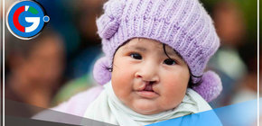 Hospital Carrión operarán 180 pacientes con labio leporino