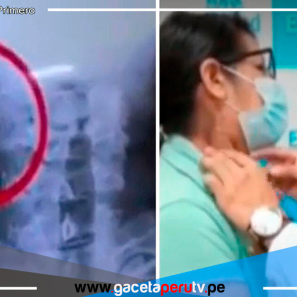 La Victoria: Mujer se traga un clavo mientras comía pan con chicharrón