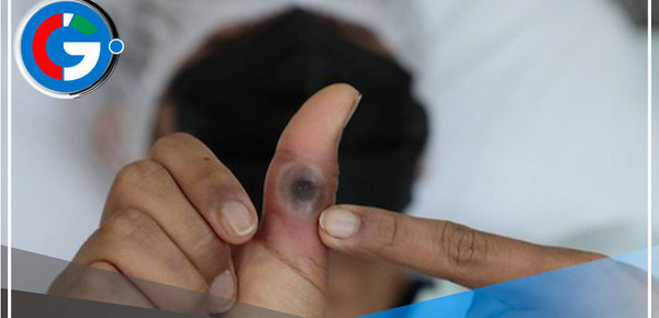 Viruela del Mono:  ¿Cuáles son sus síntomas y cómo se evita? 