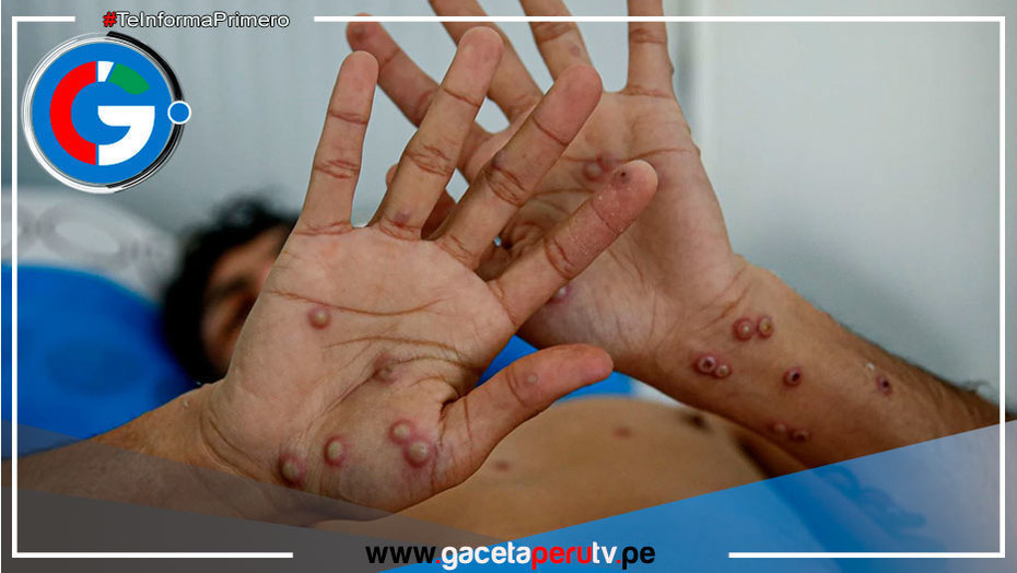 Viruela del mono: Declaran nuevamente como emergencia internacional de salud pública