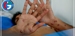 Viruela del mono: Declaran nuevamente como emergencia internacional de salud pública