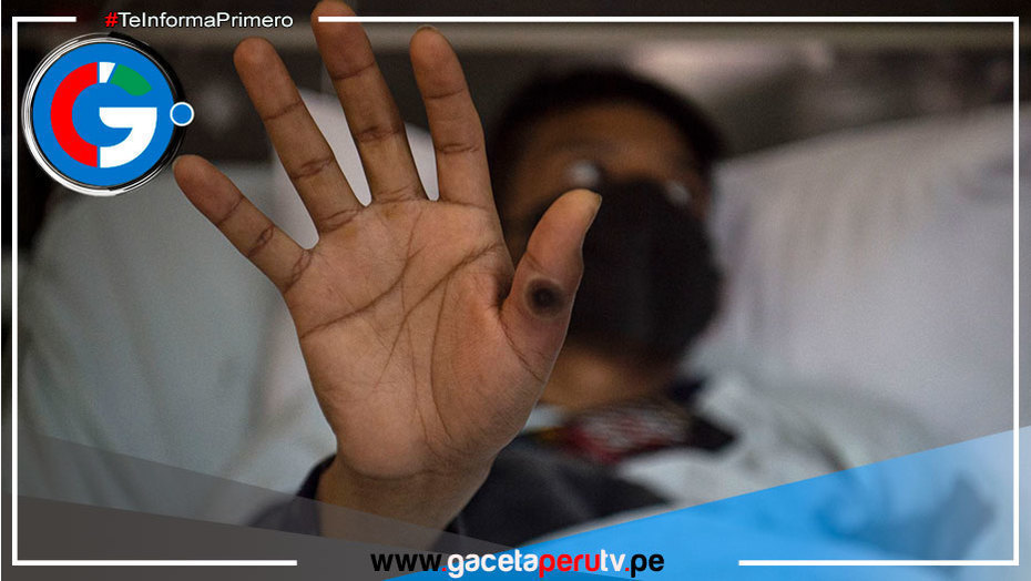 Piden 135 millones de dólares al mundo para frenar brotes de mpox en África