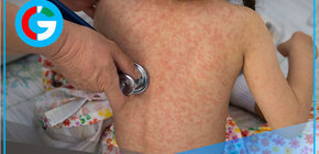 México: Sarampión causa cuatro muertes y 1,629 contagios confirmados