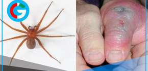 INS advierte aumento de mordeduras de araña casera 