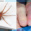 INS advierte aumento de mordeduras de araña casera 